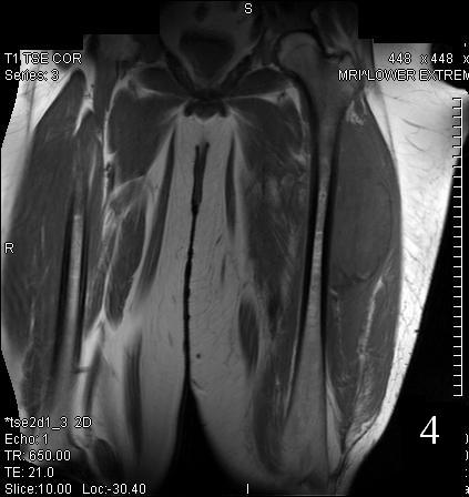 Tumor Surgery : Bone Cancer Tumors : Sarcoma Surgeon : NYC